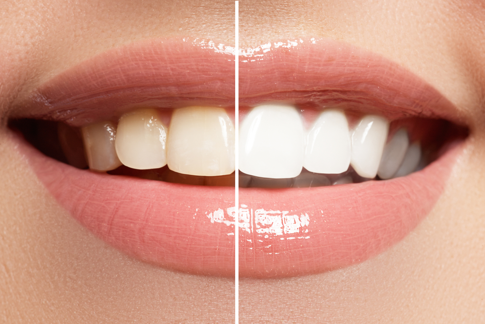 Teeth Whitening in Long Beach: Your Complete Guide