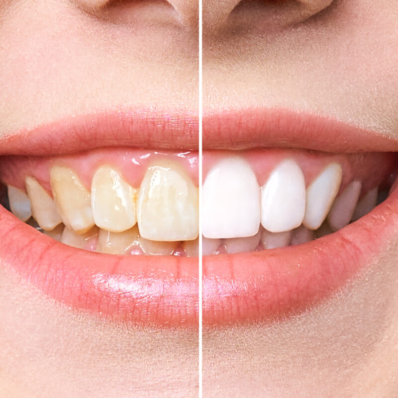 Woman,Teeth,Before,And,After,Whitening.,Over,White,Background.,Dental