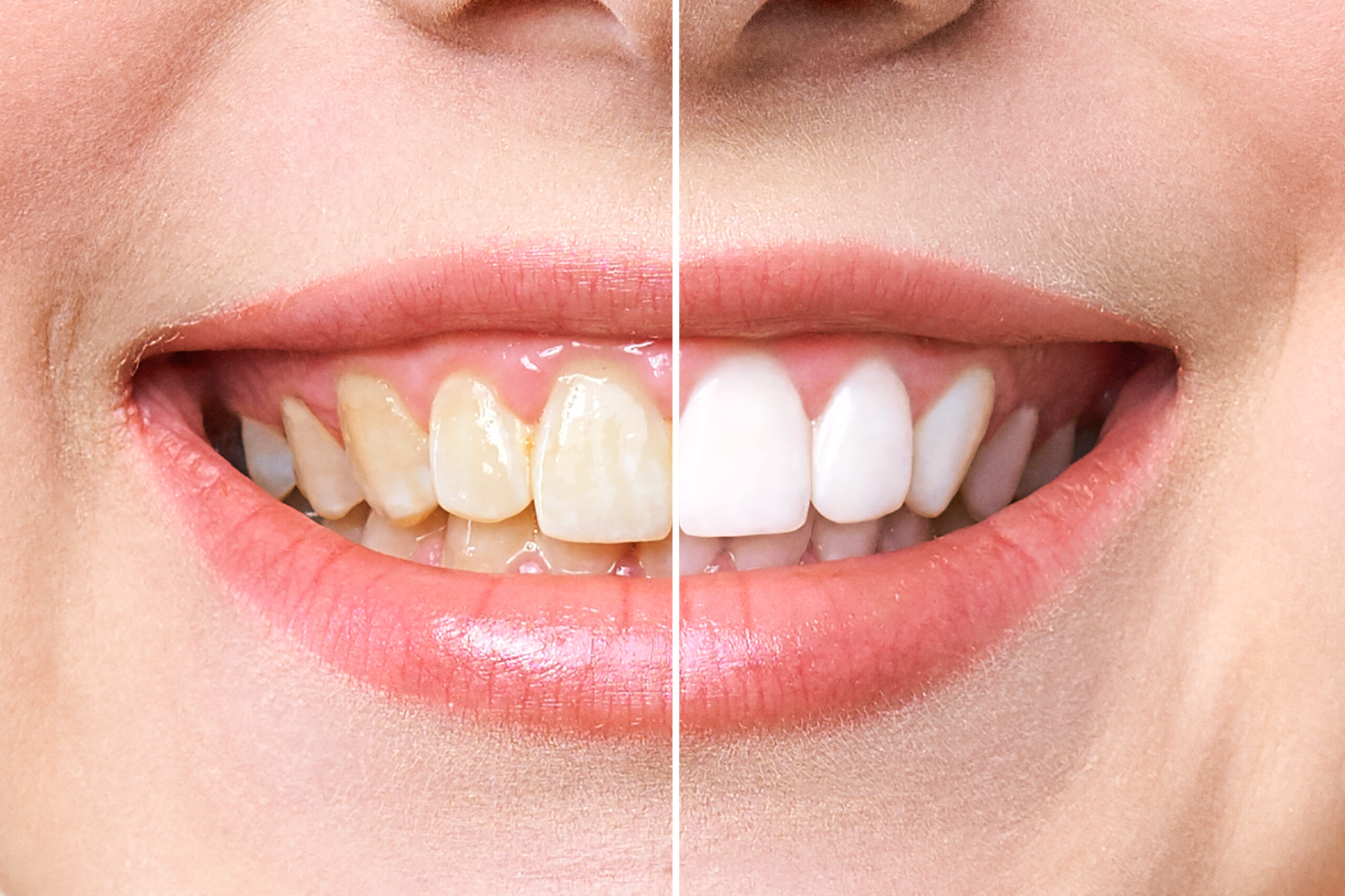Home Remedies vs. Professional Teeth Whitening: Your Guide to a Brighter Smile