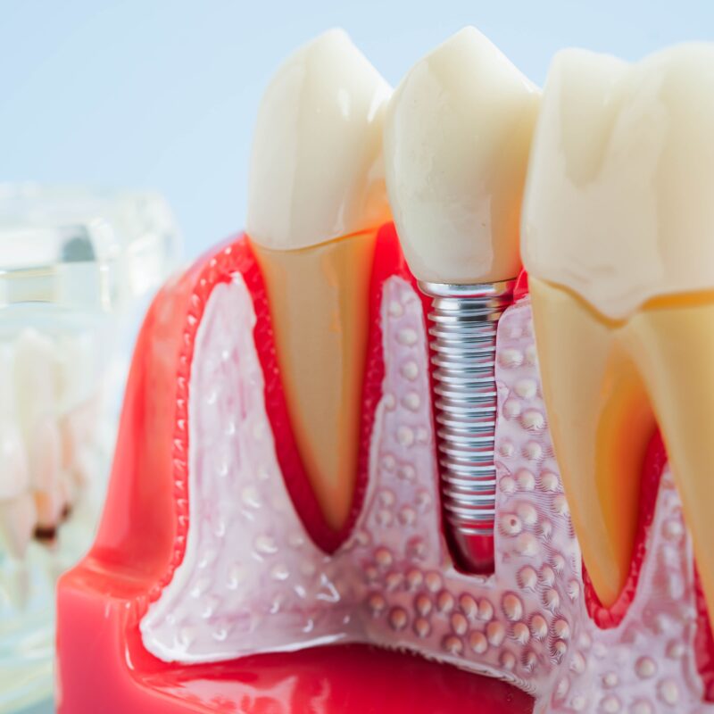 Artificial,Tooth,Roots,Dental,Implant,Into,Jaw,Root,Canal,Model