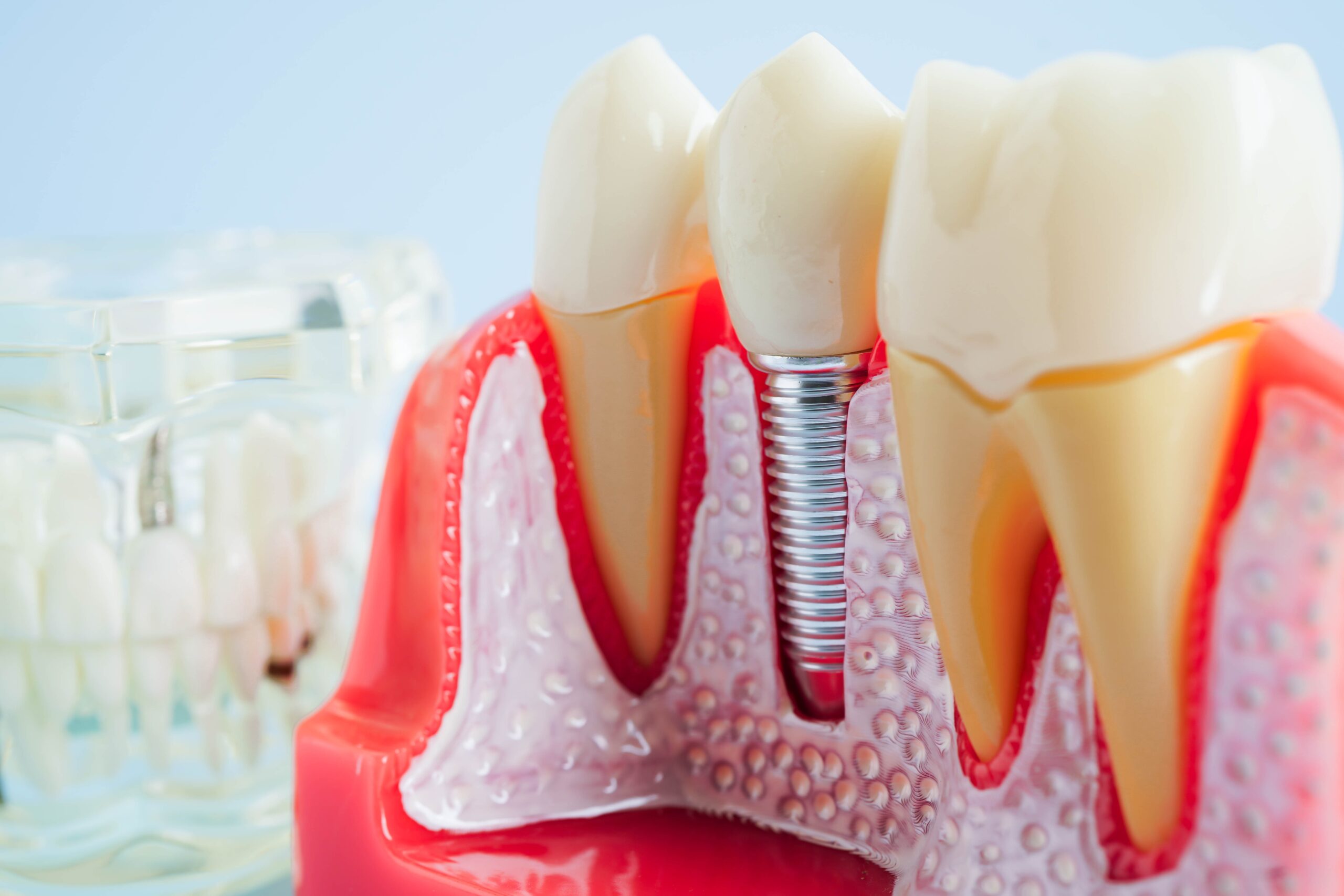 Dental Implants Long Beach | Restore Your Smile